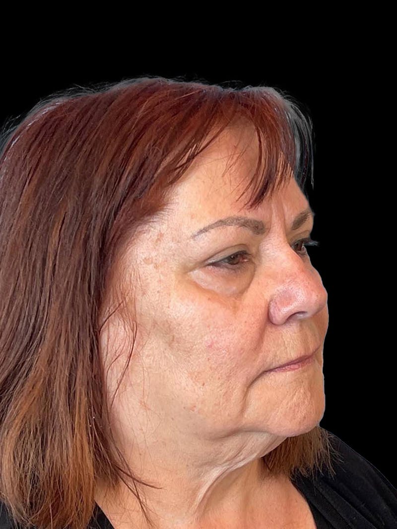 Blepharoplasty Before & After Gallery - Patient 121491 - Image 7