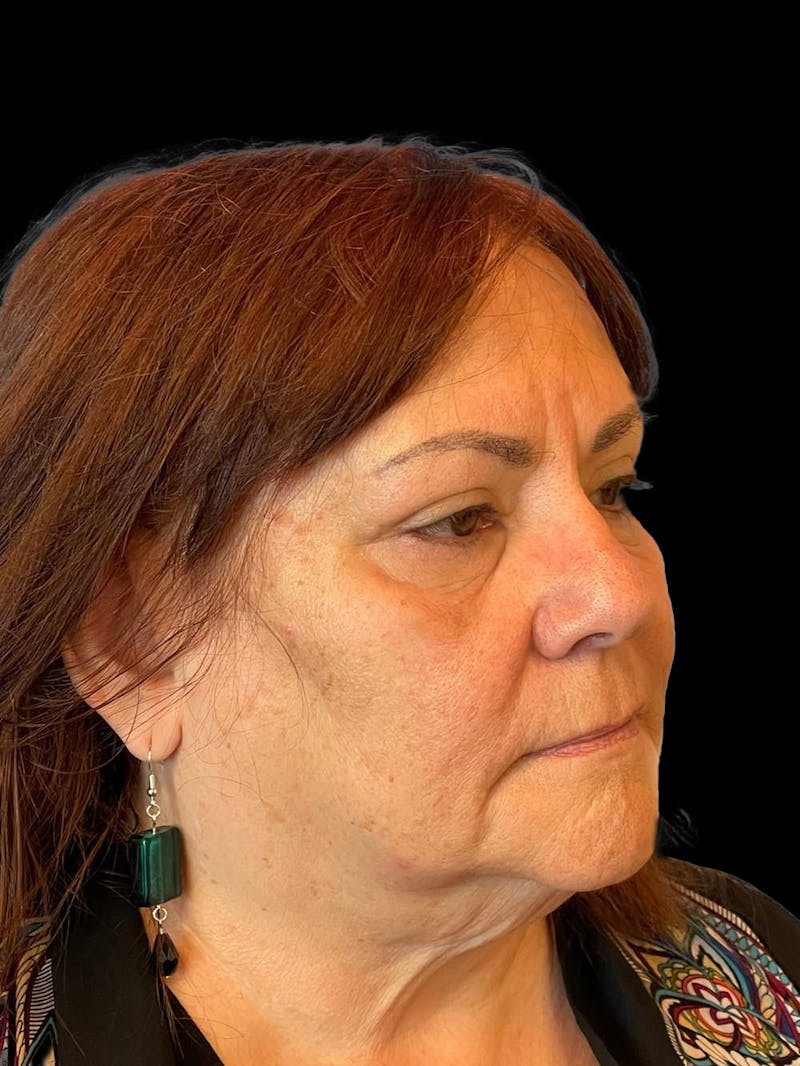 Blepharoplasty Before & After Gallery - Patient 121491 - Image 8