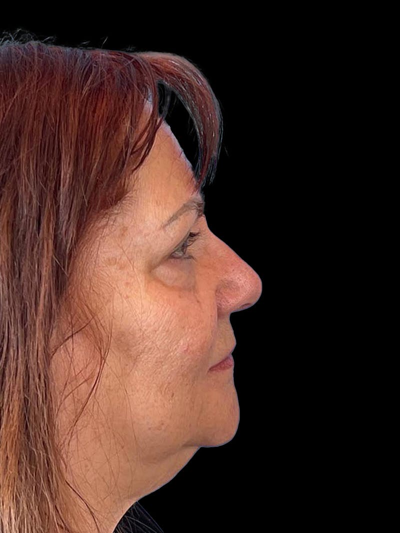 Blepharoplasty Before & After Gallery - Patient 121491 - Image 9