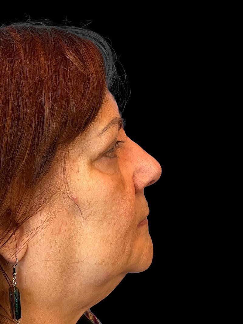 Blepharoplasty Before & After Gallery - Patient 121491 - Image 10