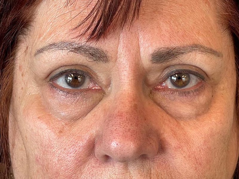 Blepharoplasty Before & After Gallery - Patient 121491 - Image 11