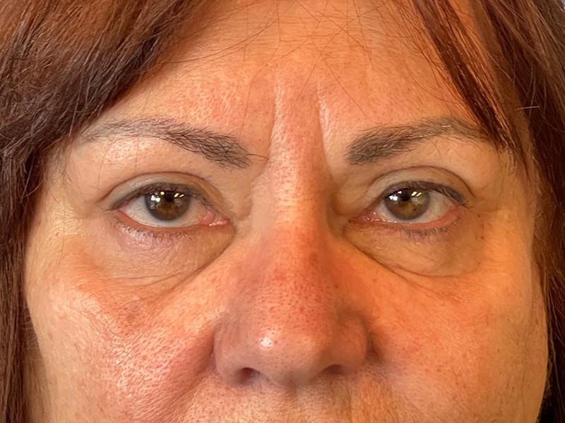 Blepharoplasty Before & After Gallery - Patient 121491 - Image 12