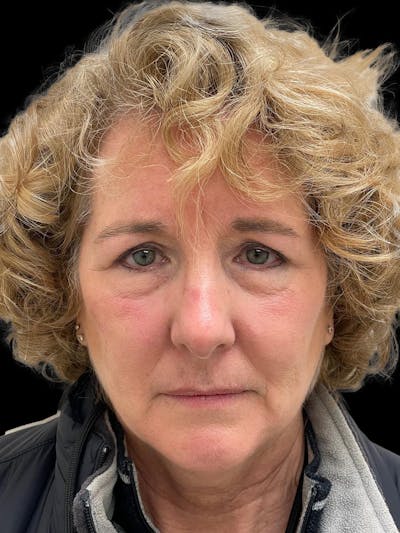 Browlift Before & After Gallery - Patient 842733 - Image 1