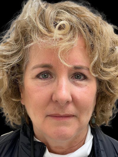 Browlift Before & After Gallery - Patient 842733 - Image 2