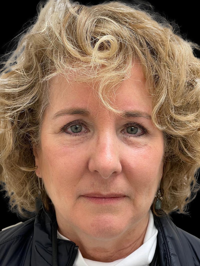 Browlift Before & After Gallery - Patient 842733 - Image 2