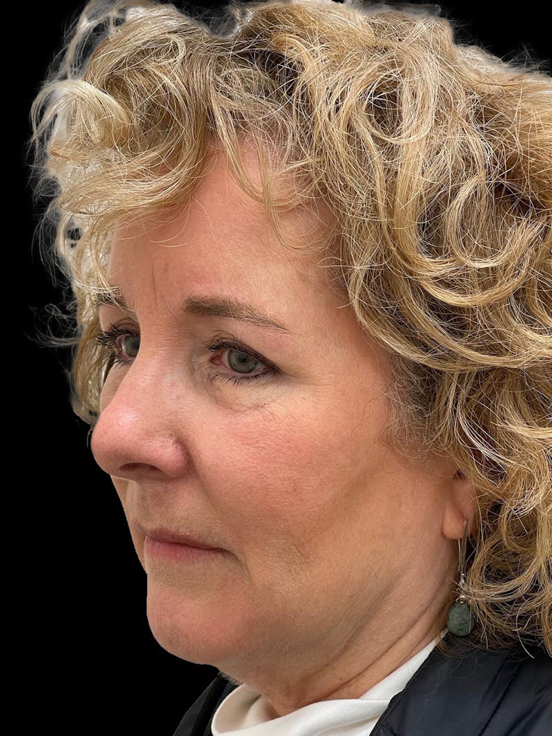 Browlift Before & After Gallery - Patient 842733 - Image 4