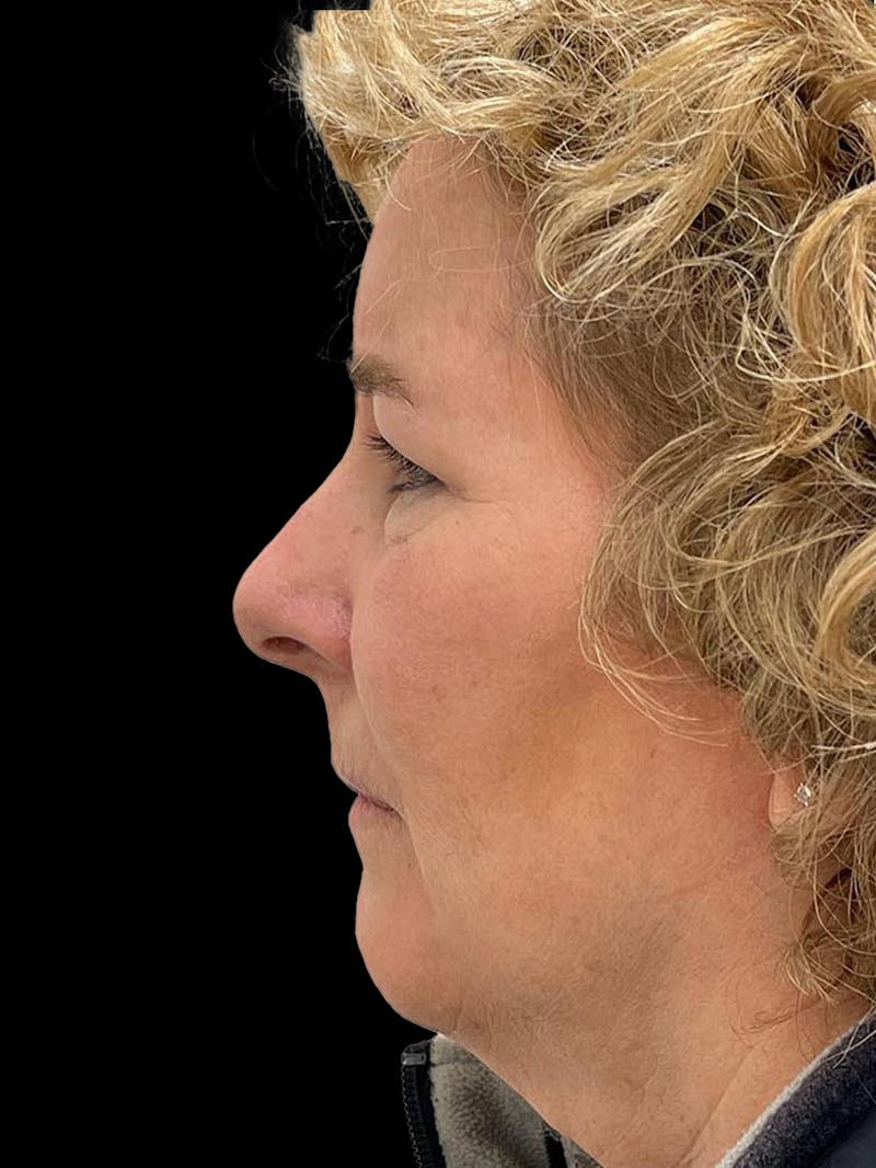 Browlift Before & After Gallery - Patient 842733 - Image 5
