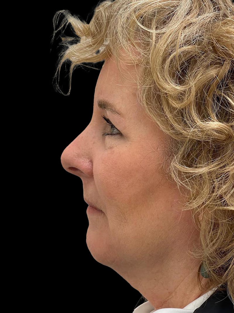 Browlift Before & After Gallery - Patient 842733 - Image 6