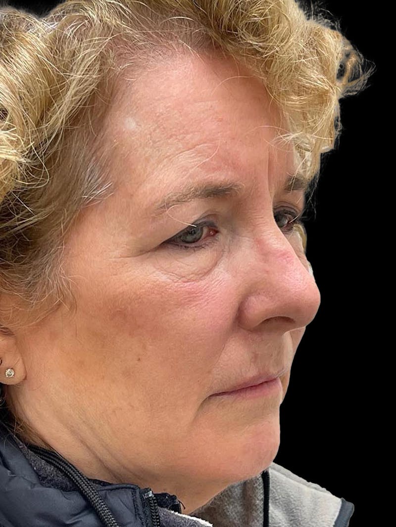 Browlift Before & After Gallery - Patient 842733 - Image 7