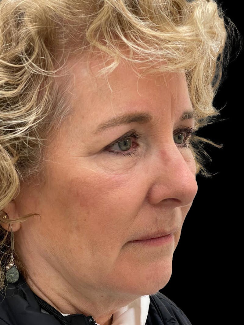 Browlift Before & After Gallery - Patient 842733 - Image 8