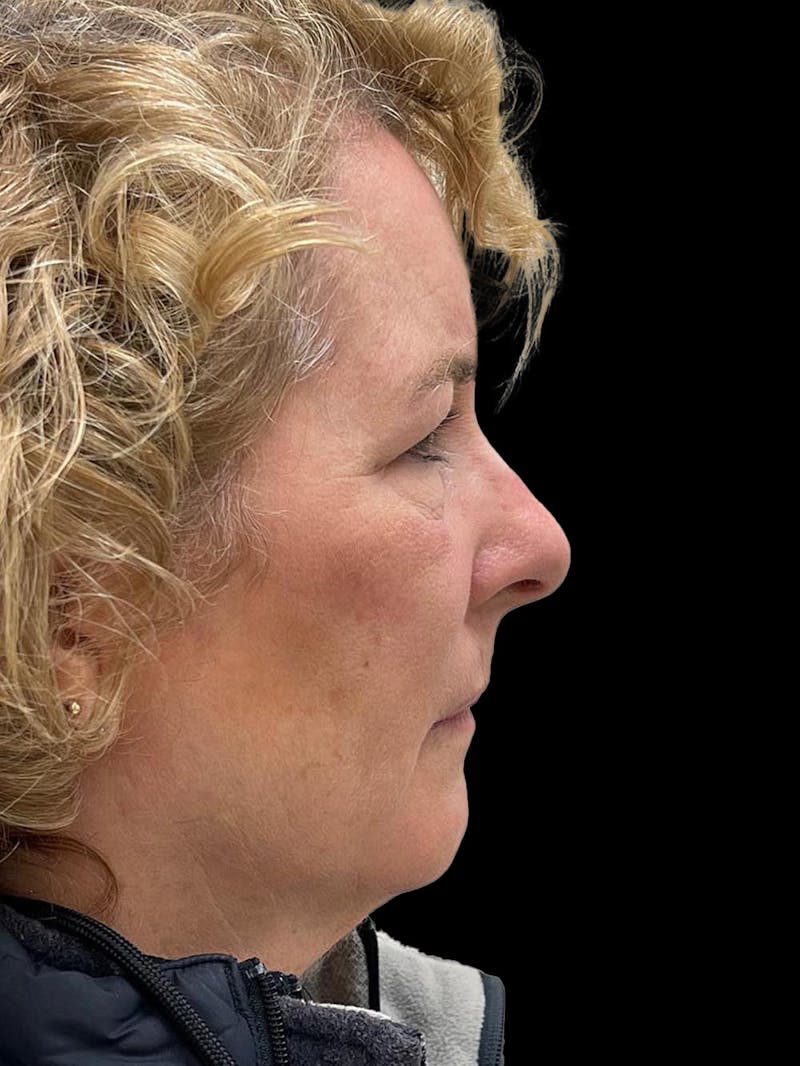 Browlift Before & After Gallery - Patient 842733 - Image 9