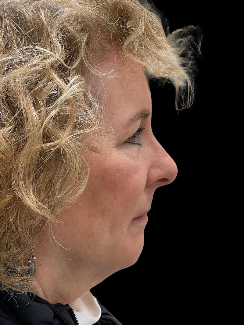 Browlift Before & After Gallery - Patient 842733 - Image 10