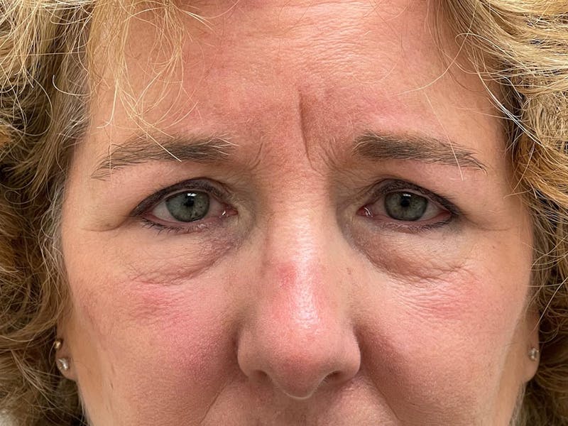 Browlift Before & After Gallery - Patient 842733 - Image 11