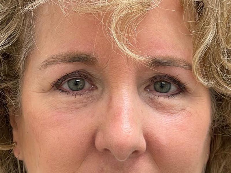 Browlift Before & After Gallery - Patient 842733 - Image 12