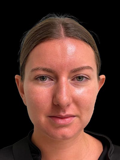 Otoplasty Before & After Gallery - Patient 333569 - Image 1
