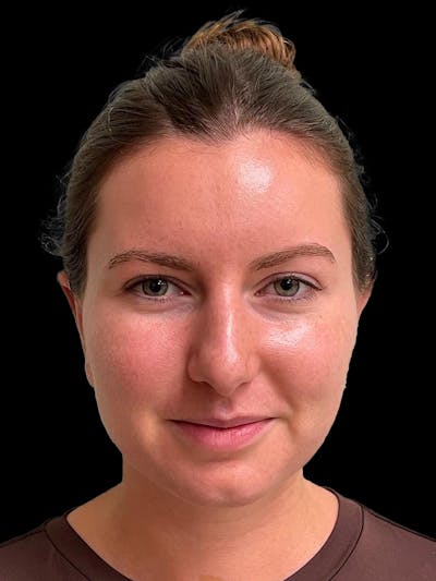 Otoplasty Before & After Gallery - Patient 333569 - Image 2