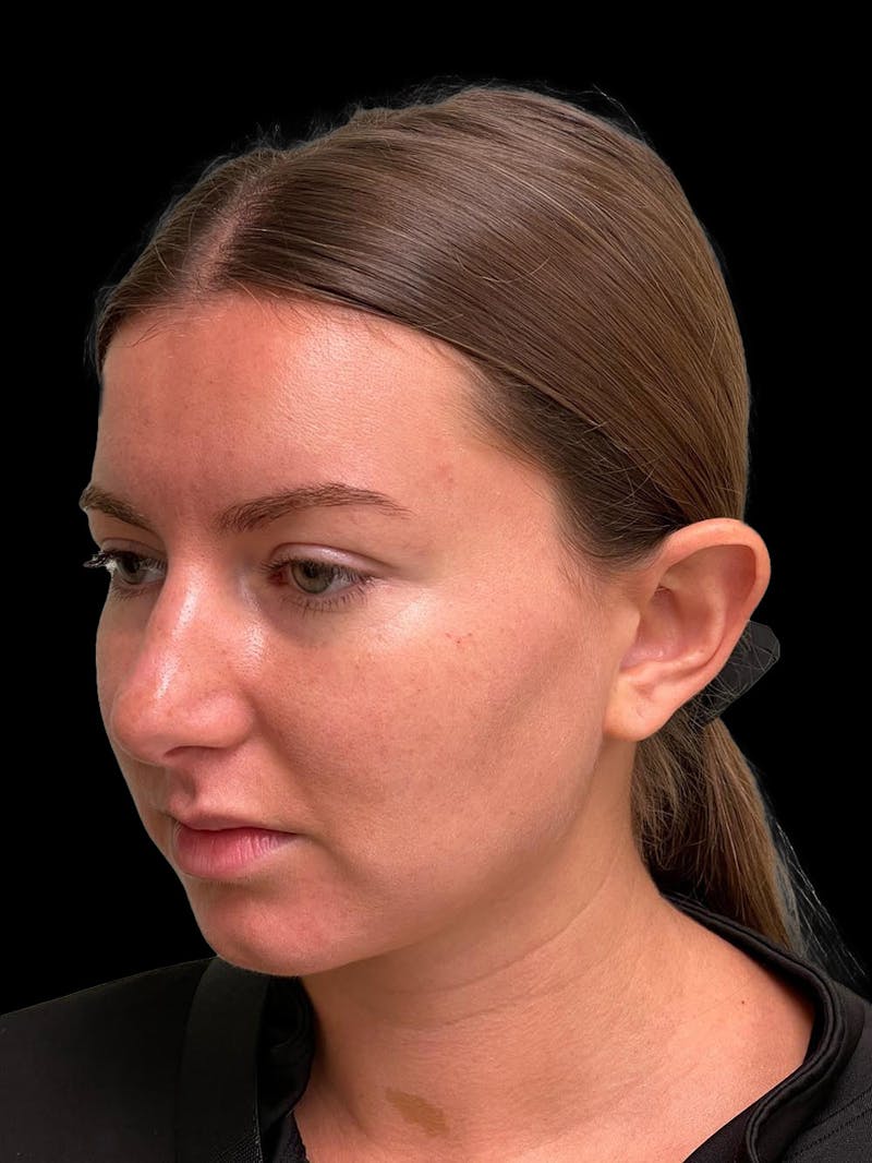 Otoplasty Before & After Gallery - Patient 333569 - Image 3