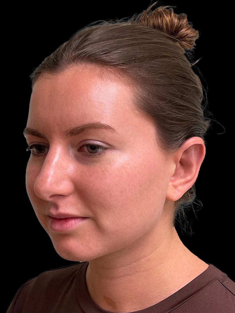 Otoplasty Before & After Gallery - Patient 333569 - Image 4