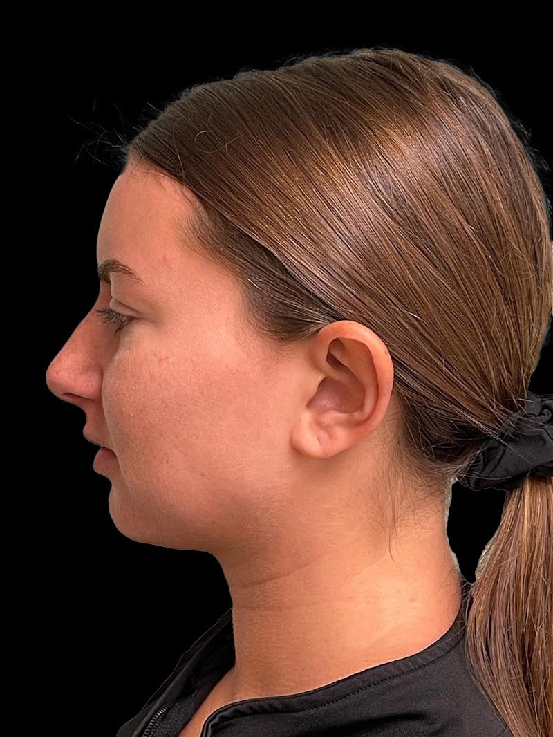 Otoplasty Before & After Gallery - Patient 333569 - Image 5
