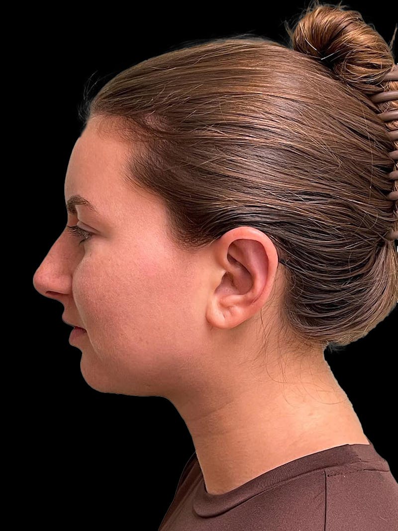 Otoplasty Before & After Gallery - Patient 333569 - Image 6