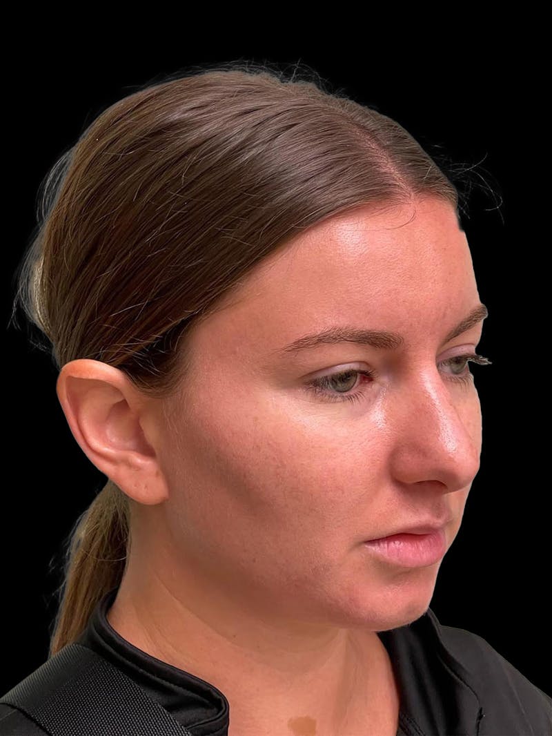 Otoplasty Before & After Gallery - Patient 333569 - Image 7
