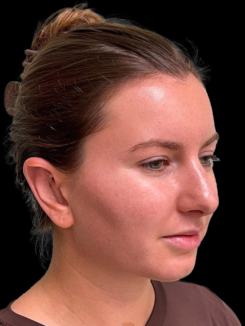 Otoplasty Before & After Gallery - Patient 333569 - Image 8