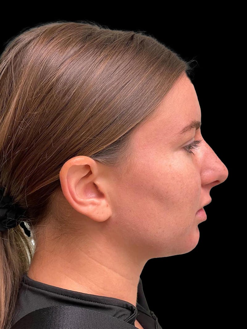Otoplasty Before & After Gallery - Patient 333569 - Image 9