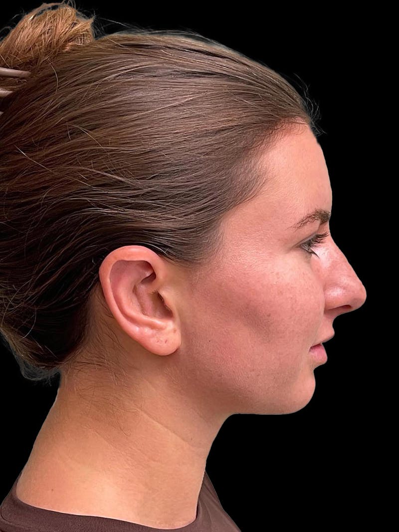 Otoplasty Before & After Gallery - Patient 333569 - Image 10