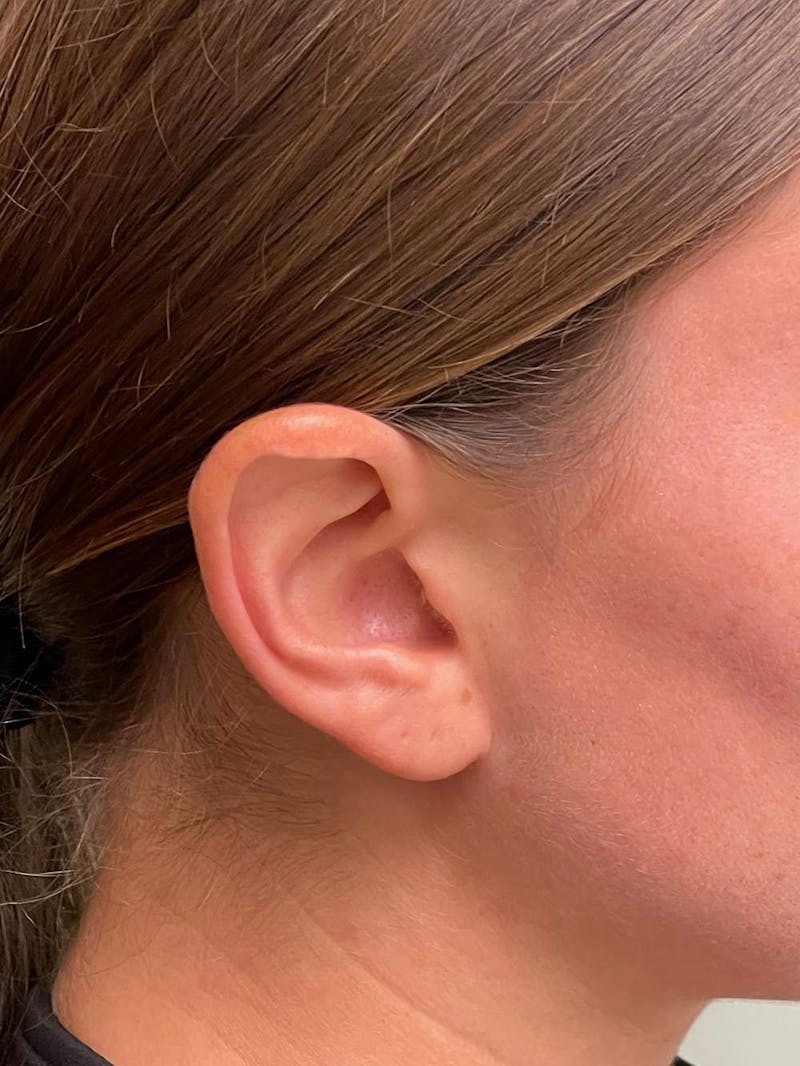 Otoplasty Before & After Gallery - Patient 333569 - Image 15