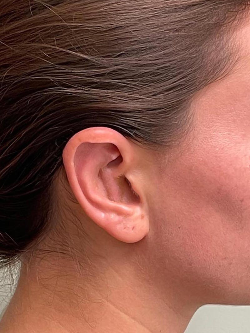 Otoplasty Before & After Gallery - Patient 333569 - Image 16