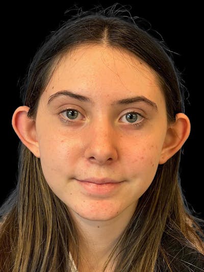 Otoplasty Before & After Gallery - Patient 304864 - Image 1