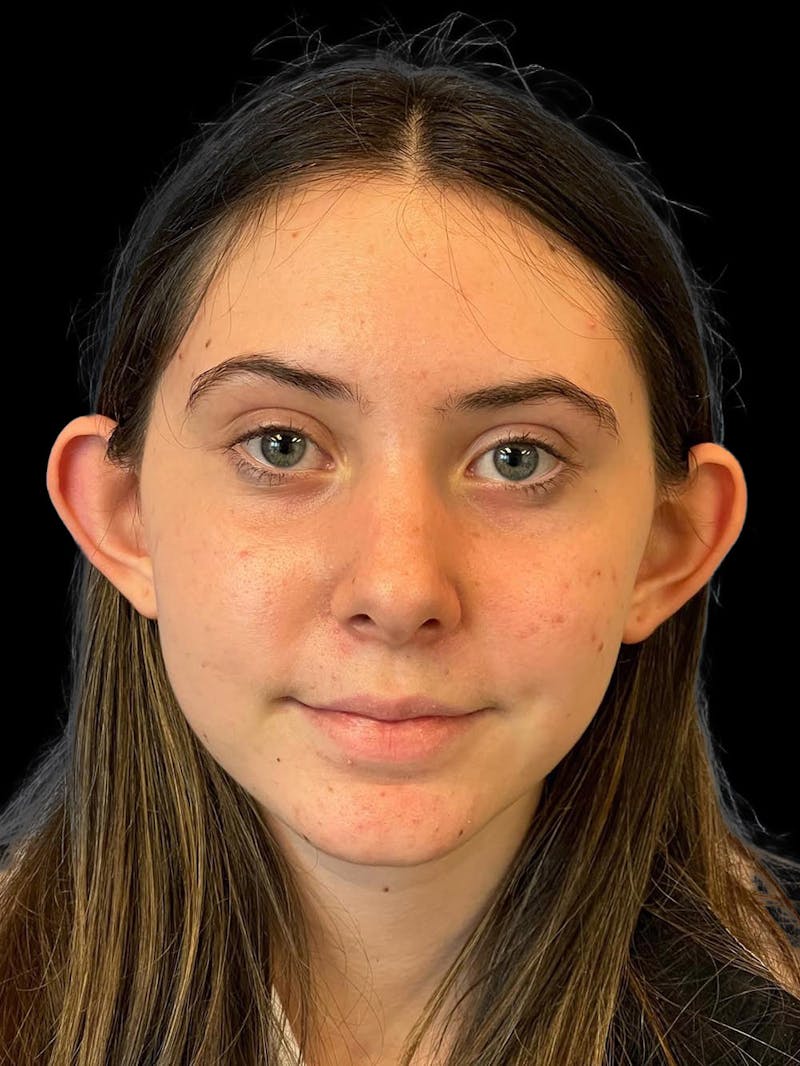 Otoplasty Before & After Gallery - Patient 304864 - Image 1