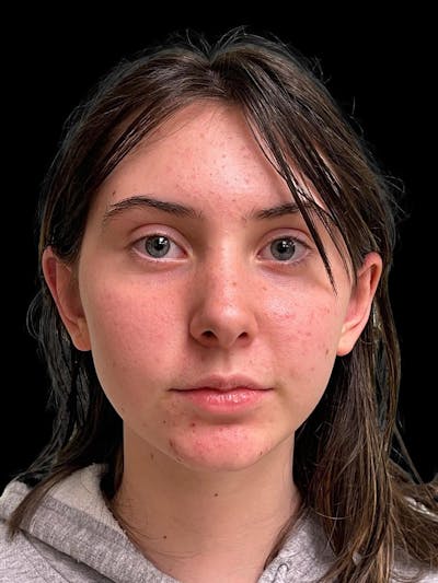 Otoplasty Before & After Gallery - Patient 304864 - Image 2