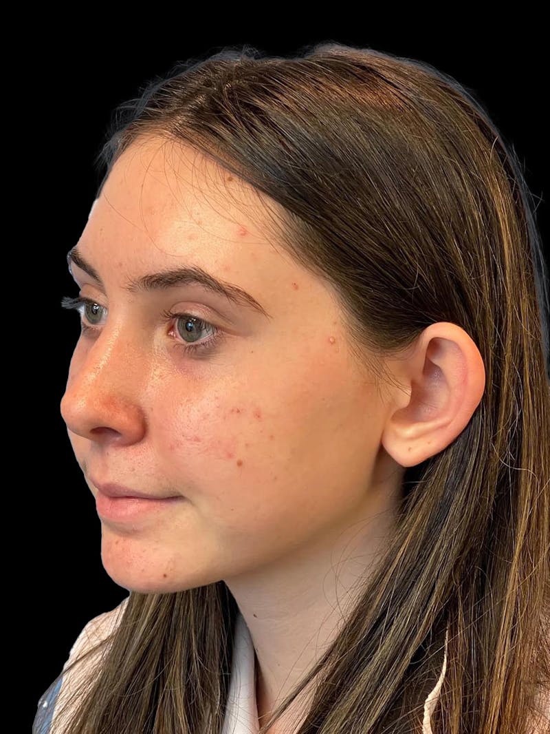 Otoplasty Before & After Gallery - Patient 304864 - Image 3