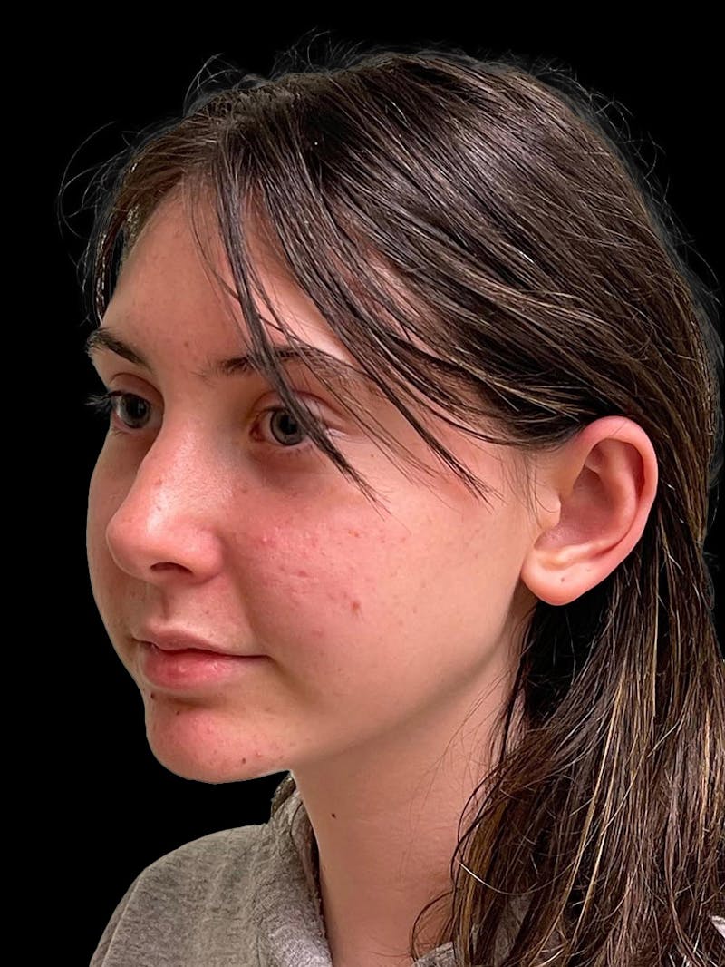 Otoplasty Before & After Gallery - Patient 304864 - Image 4