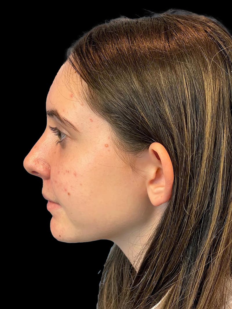 Otoplasty Before & After Gallery - Patient 304864 - Image 5