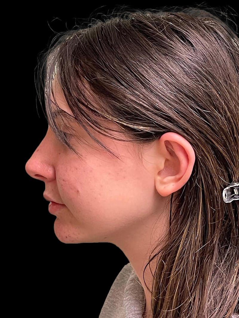 Otoplasty Before & After Gallery - Patient 304864 - Image 6