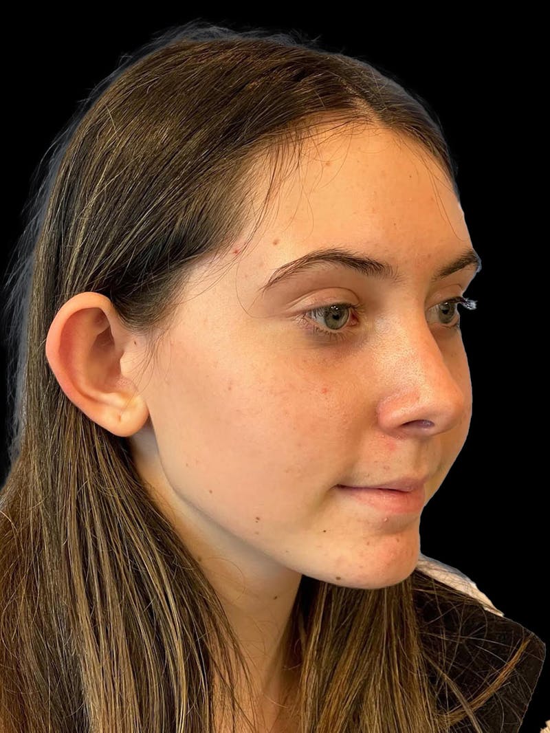 Otoplasty Before & After Gallery - Patient 304864 - Image 7