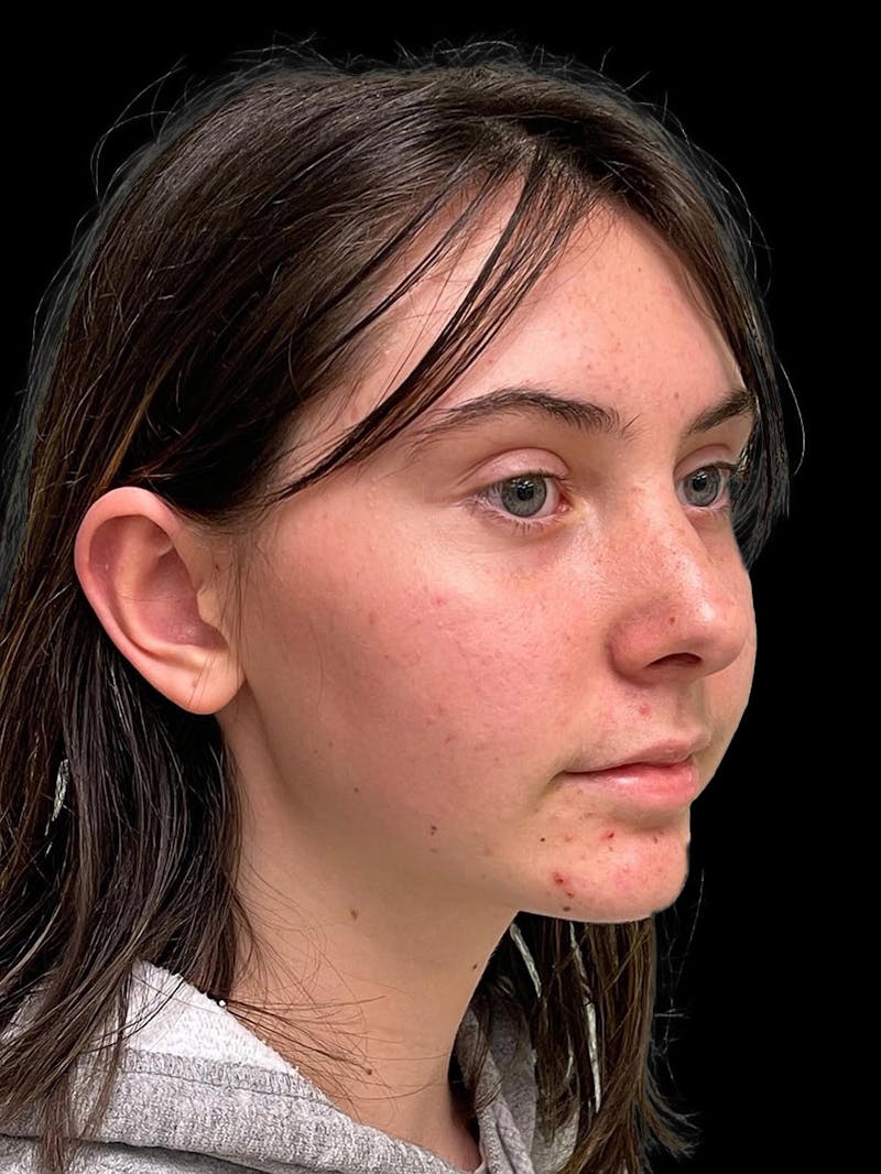 Otoplasty Before & After Gallery - Patient 304864 - Image 8