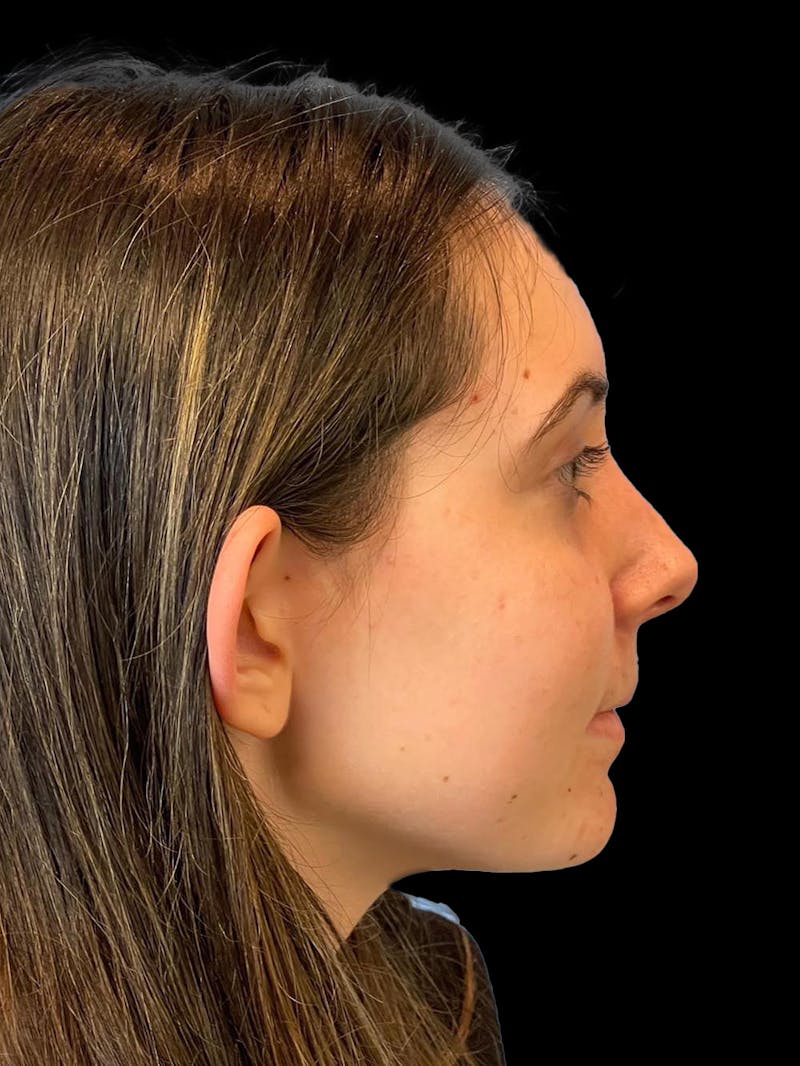 Otoplasty Before & After Gallery - Patient 304864 - Image 9
