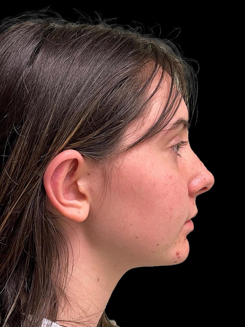 Otoplasty Before & After Gallery - Patient 304864 - Image 10