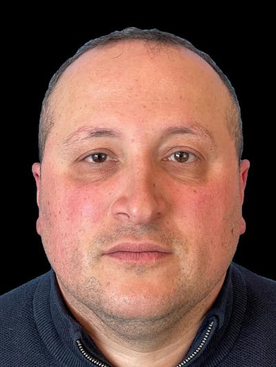 Rhinoplasty Before & After Gallery - Patient 511709 - Image 1