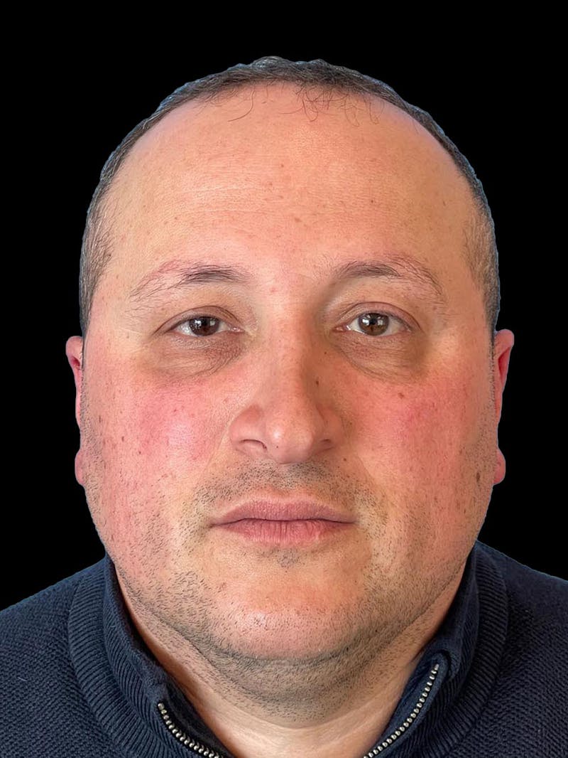 Rhinoplasty Before & After Gallery - Patient 511709 - Image 1
