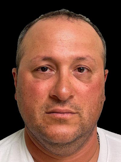 Rhinoplasty Before & After Gallery - Patient 511709 - Image 2