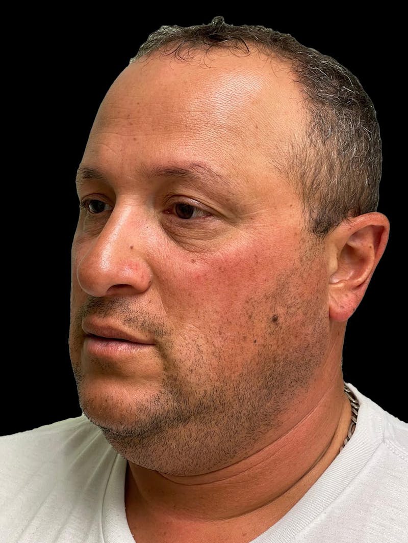 Rhinoplasty Before & After Gallery - Patient 511709 - Image 4