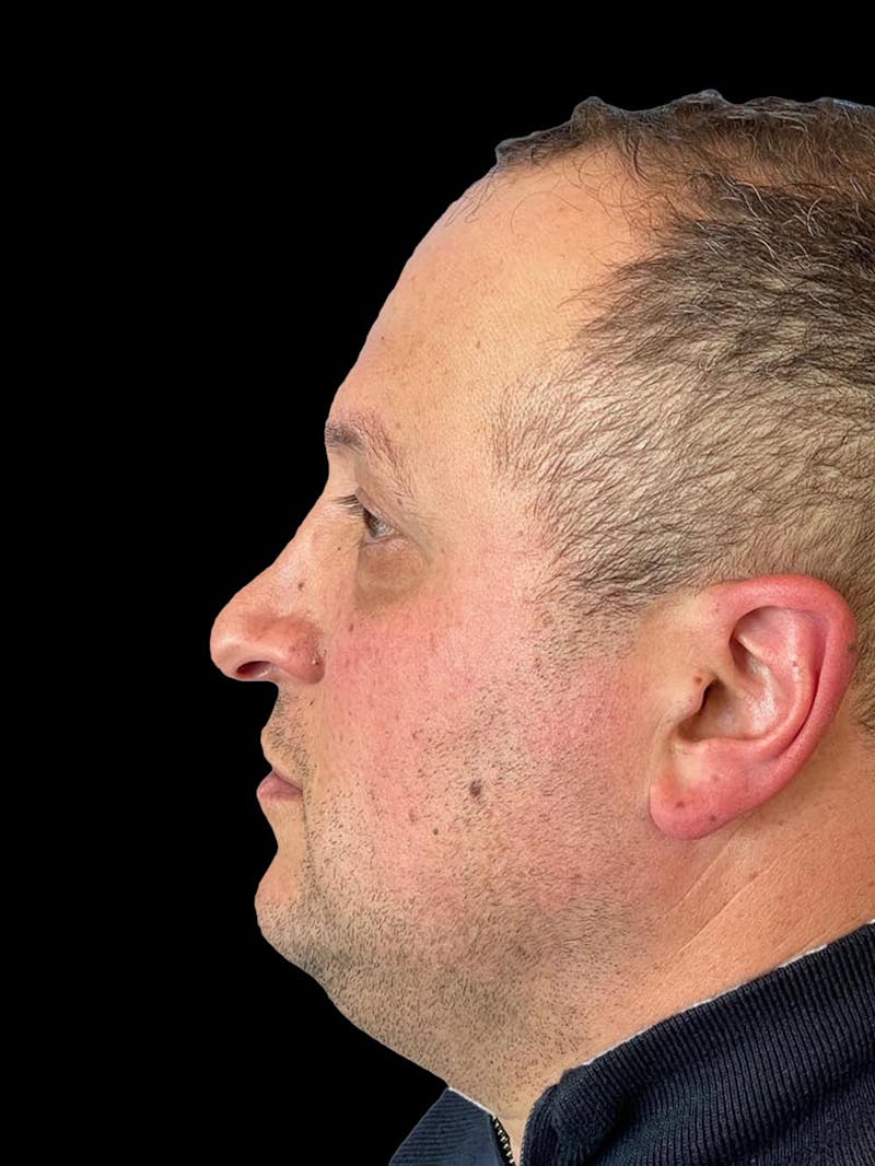 Rhinoplasty Before & After Gallery - Patient 511709 - Image 5