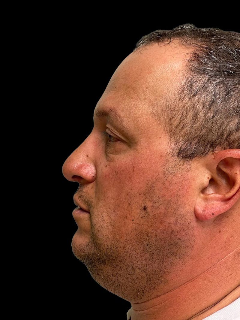 Rhinoplasty Before & After Gallery - Patient 511709 - Image 6