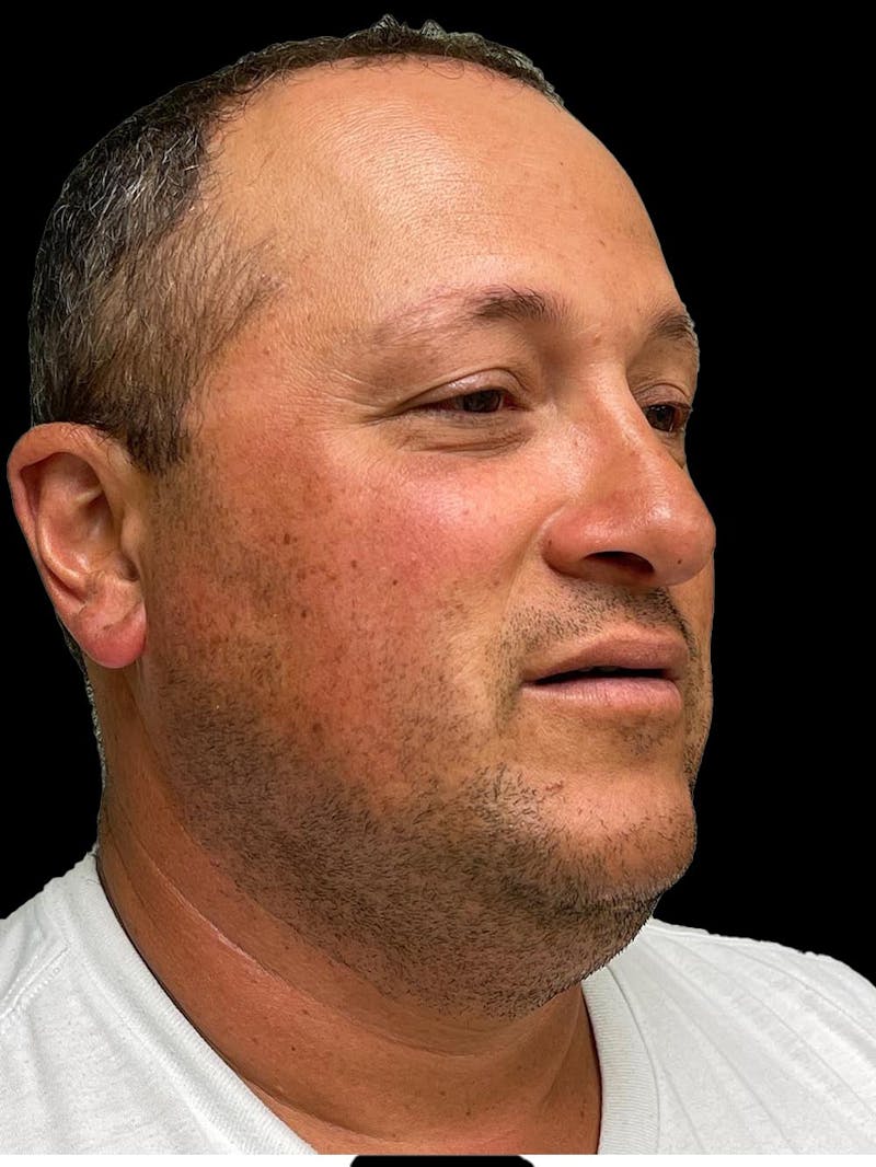 Rhinoplasty Before & After Gallery - Patient 511709 - Image 8