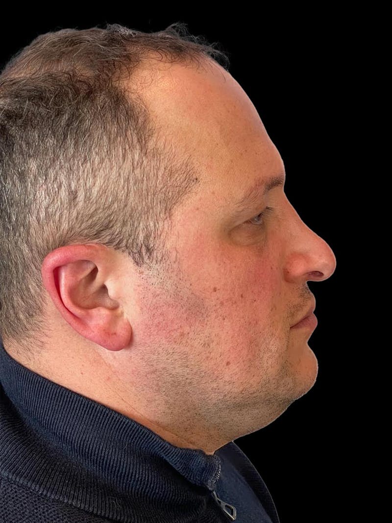 Rhinoplasty Before & After Gallery - Patient 511709 - Image 9