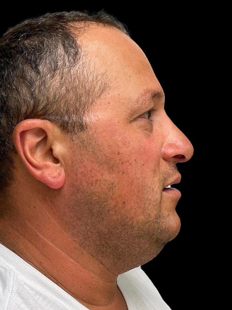 Rhinoplasty Before & After Gallery - Patient 511709 - Image 10